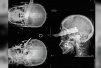 Mulher tem faca cravada no olho em tentativa de feminicídio no Oeste de SC