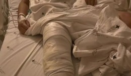 "Ambas as pernas comprometidas', diz filha de idosa que teve prótese implantada no joelho errado