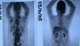 Paciente comemora remissão total do câncer após CAR-T Cell: 'Auge de uma luta de 13 anos'