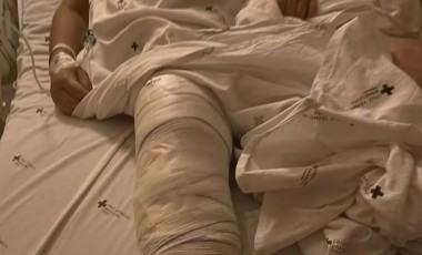 "Ambas as pernas comprometidas', diz filha de idosa que teve prótese implantada no joelho errado